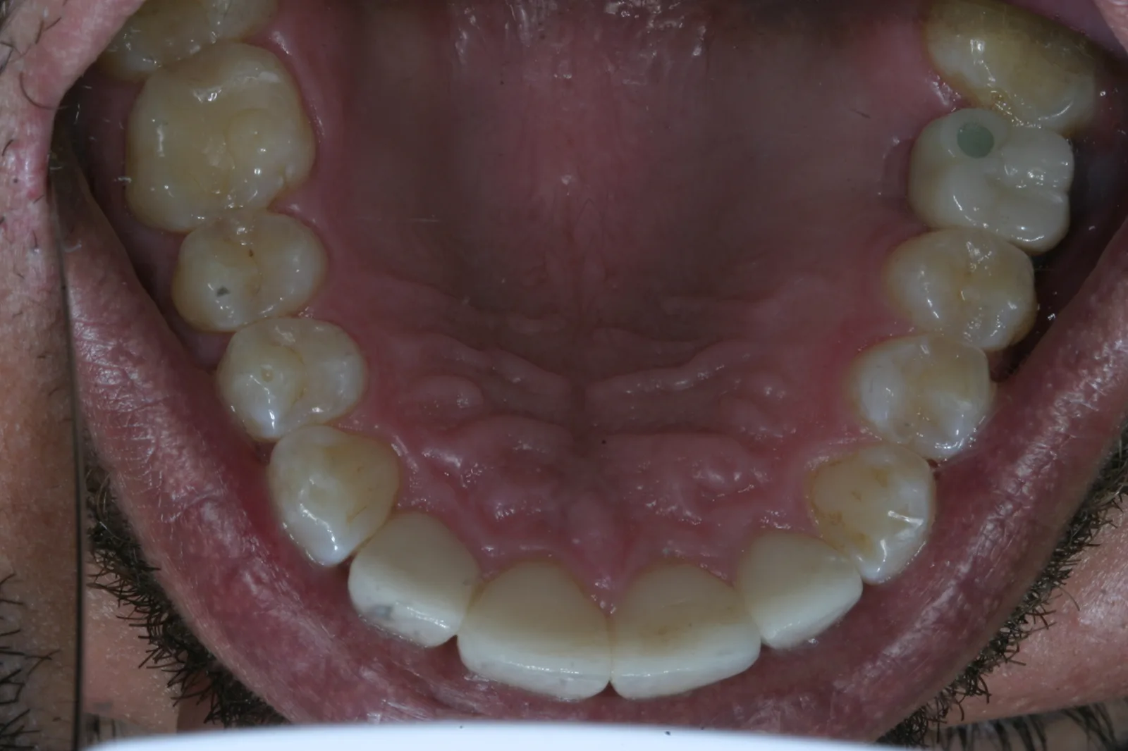 Smile gallery case 10 — after treatment