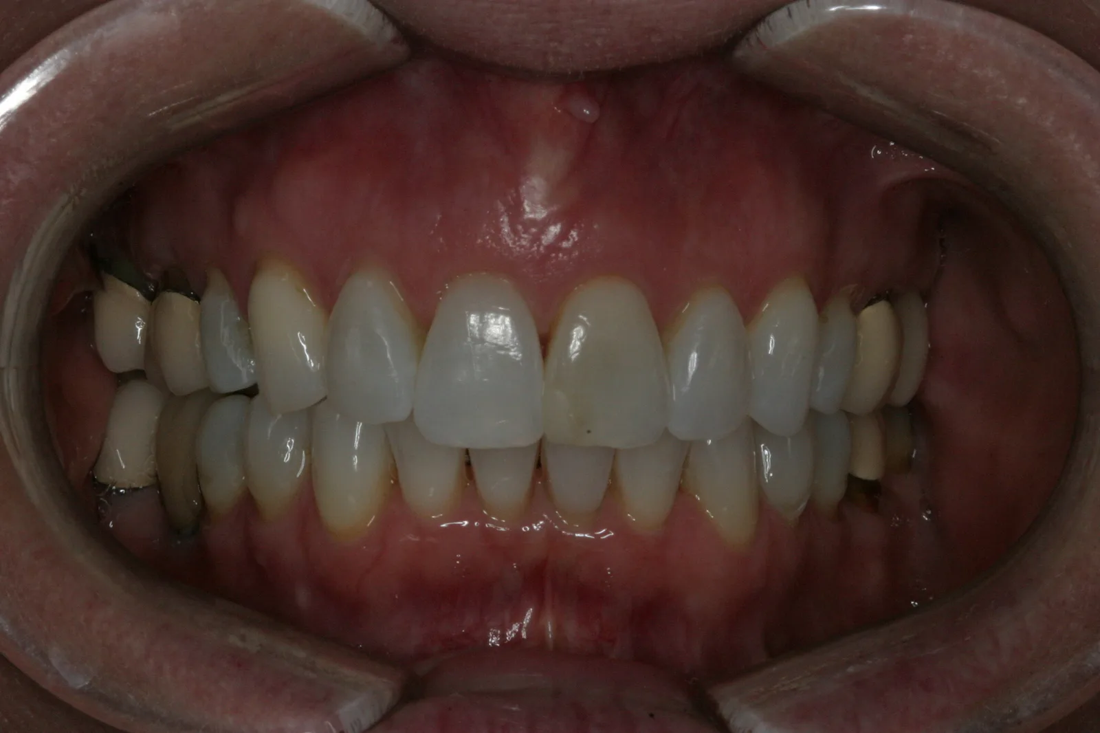 Smile gallery case 6, second example — before treatment