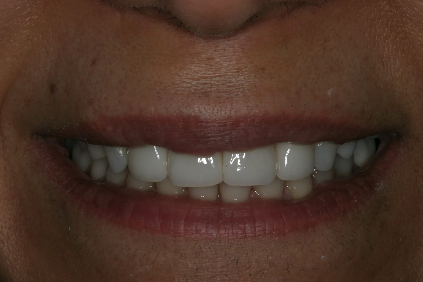 Smile gallery case 7 — before treatment